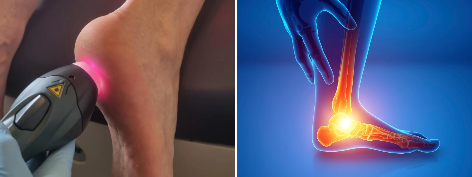 Plantar Fasciitis The Runner’s Nightmare 